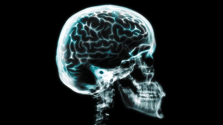Gehirn: Die Heilmittelforschung bei Alzheimer läuft auf Hochtouren. Getty Images